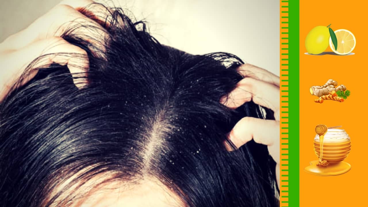 How to Remove Dandruff Naturally at Home?