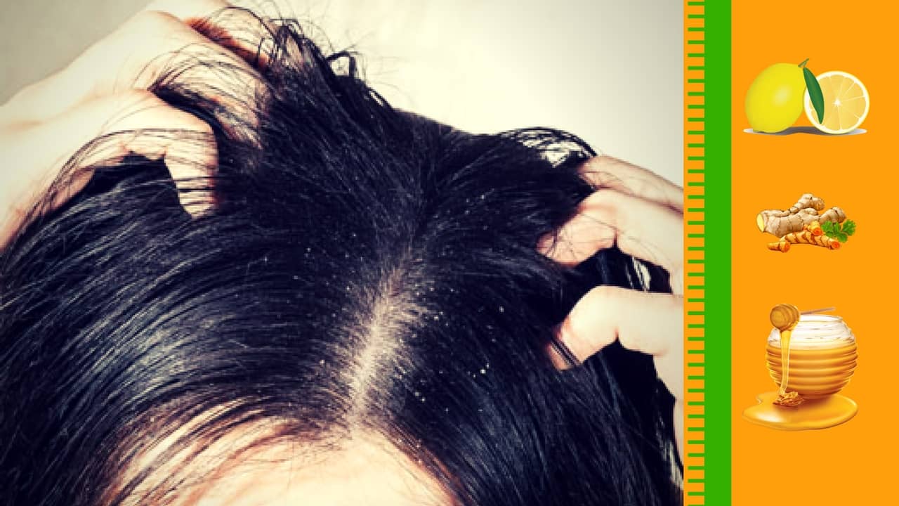 How to Get Rid of Dandruff