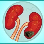 Kidney Disease in India