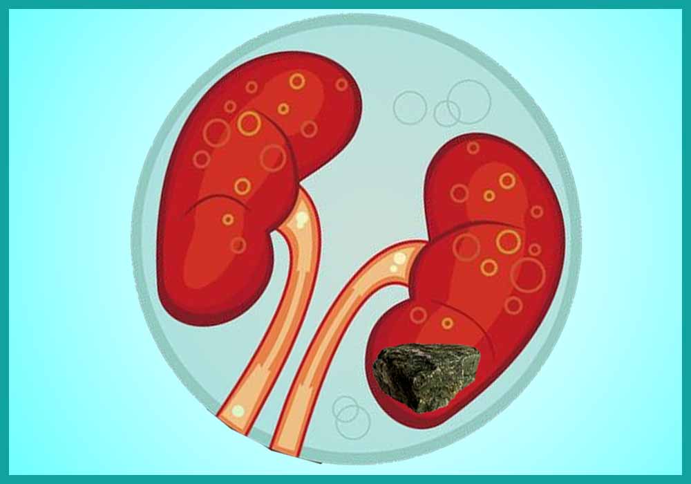 Kidney Stones