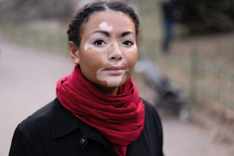 Girl with Vitiligo