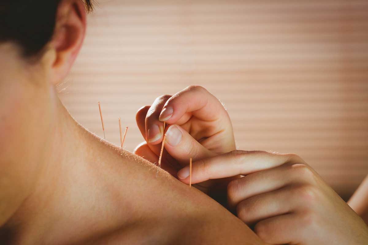 All you need to know about Acupuncture !