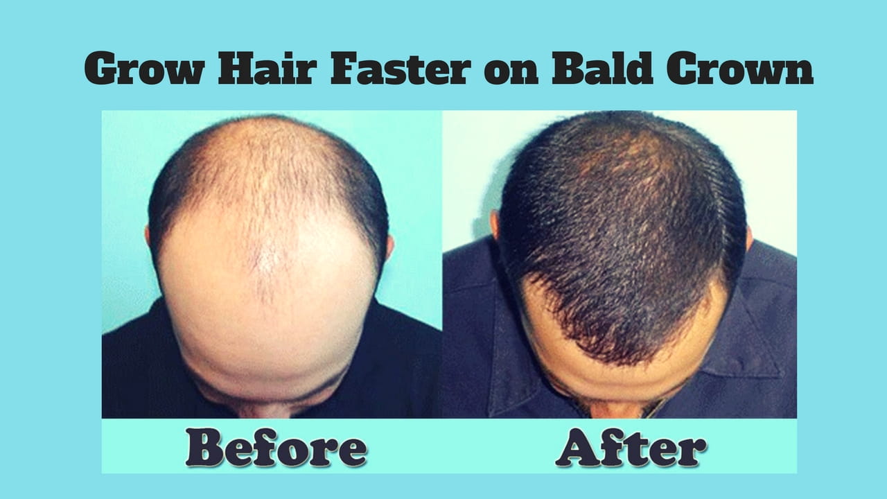 How to Grow Hair Faster on Bald Crown? 5 Hair Re-growth Tips!