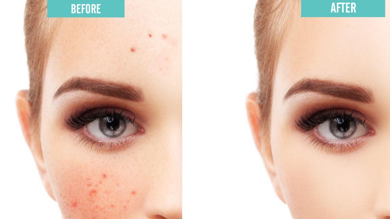 how to get rid of pimple marks on face overnight