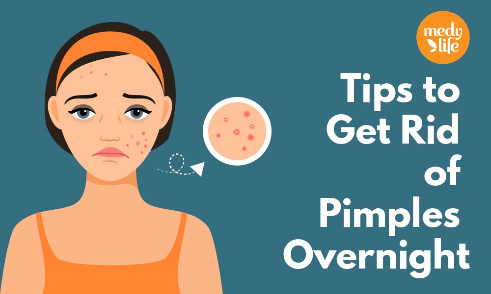 All you wanted to know about Pimples and its Treatment.