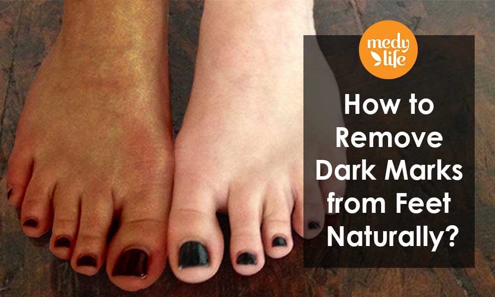 How to Remove Dark Marks from Feet Naturally