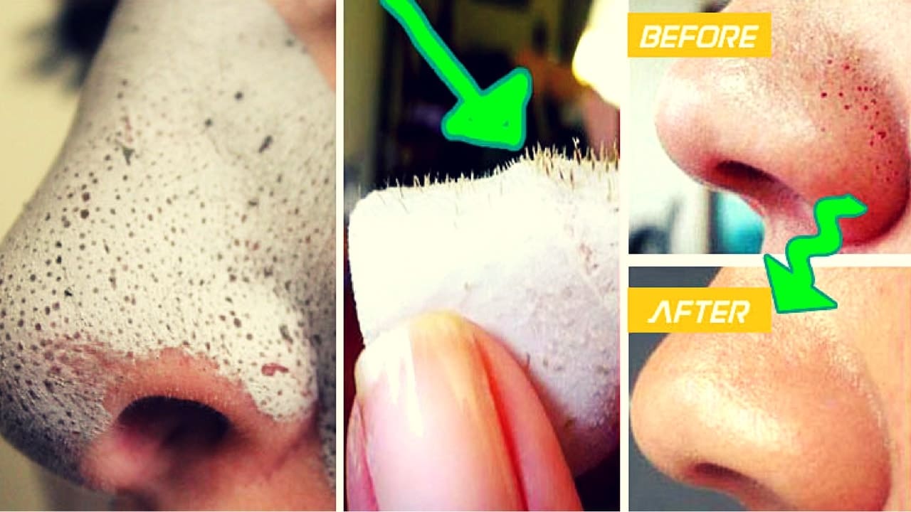 blackhead removal