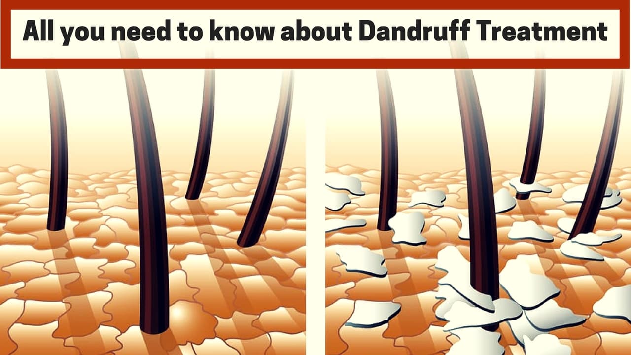 All you need to know about Dandruff Treatment! Medy Life