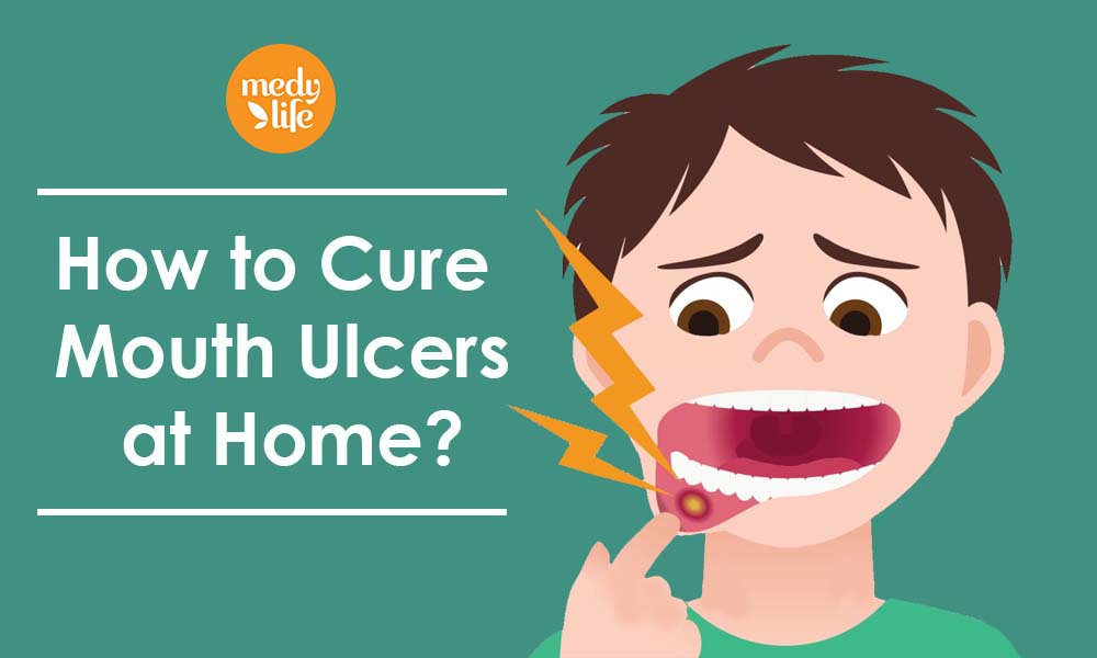 Tried and Tested Home Remedies for Mouth Ulcers!