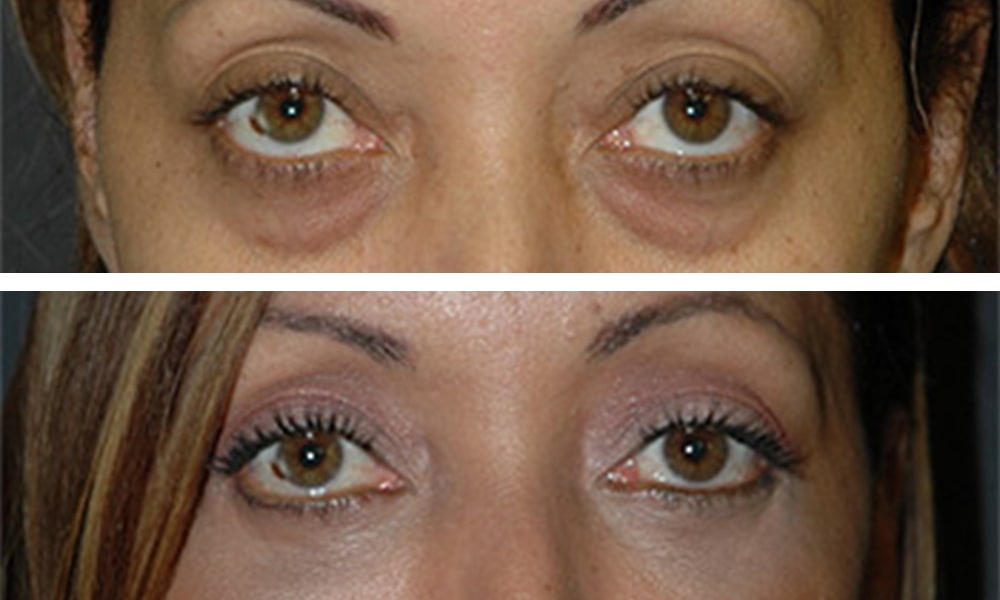 All About Asian Eyelid Surgery