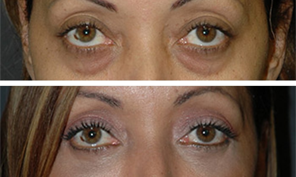 Asian Eyelid Surgery