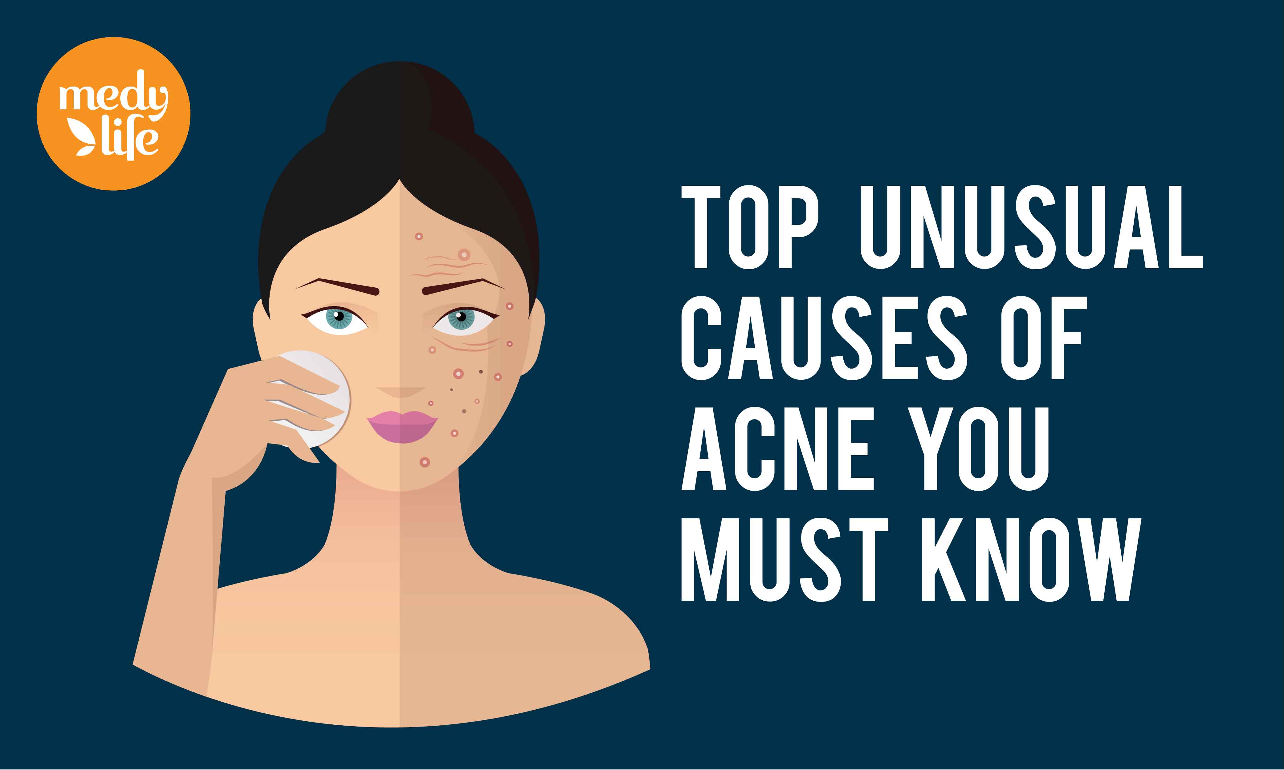 Top Unusual Causes of Acne you must Know! - Medy Life